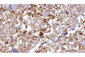 ABIN6276882 at 1/100 staining Human Melanoma tissue by IHC-P. (TFF1 antibody  (Internal Region))