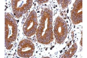 IHC-P Image Immunohistochemical analysis of paraffin-embedded human colon carcinoma, using Tetraspan 1, antibody at 1:500 dilution. (TSPAN1 antibody  (C-Term))