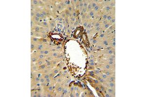 Annexin V Antibody (C-term) (ABIN390502 and ABIN2840858) IHC analysis in formalin fixed and paraffin embedded human hepatocarcinoma followed by peroxidase conjugation of the secondary antibody and DAB staining. (Annexin V antibody  (C-Term))