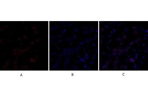Immunofluorescence analysis of human breast cancer tissue.