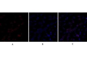 Immunofluorescence analysis of human breast cancer tissue. (DNMT3B antibody  (AA 1-80))
