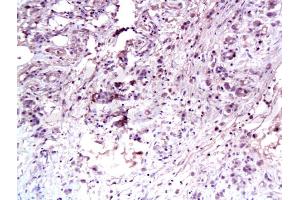 Formalin-fixed and paraffin embedded human gastric carcinoma labeled Anti-C-Met Polyclonal Antibody, Unconjugated (ABIN671661) at 1:100, followed by conjugation to the secondary antibody and DAB staining (c-MET antibody  (AA 25-150))