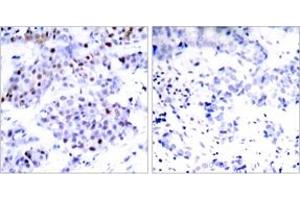 Immunohistochemistry analysis of paraffin-embedded human breast carcinoma tissue, using STAT6 (Ab-645) Antibody.