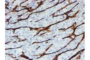 Immunohistochemical staining of paraffin-embedded Carcinoma of Human liver tissue using anti-PECAM1 mouse monoclonal antibody. (CD31 antibody)
