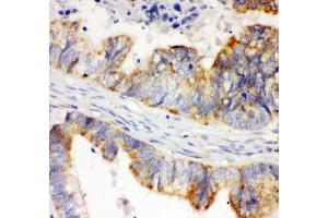 Immunohistochemistry (IHC) image for anti-Hypoxia Inducible Factor 1, alpha Subunit (Basic Helix-Loop-Helix Transcription Factor) (HIF1A) (AA 703-732) antibody (ABIN3028724)