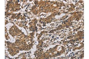 The image is immunohistochemistry of paraffin-embedded Human gastric cancer tissue using ABIN7128636(BCL2L12 Antibody) at dilution 1/20.