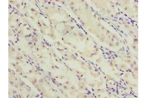 Immunohistochemistry of paraffin-embedded human gastric cancer using ABIN7170275 at dilution of 1:100 (GPR172A antibody  (AA 217-276))