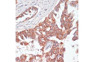 Immunohistochemistry of paraffin-embedded human lung cancer using TI antibody (ABIN6130725, ABIN6149146, ABIN6149147 and ABIN6214431) at dilution of 1:100 (40x lens). (TIAM1 antibody  (AA 1392-1591))