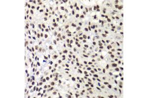 Immunohistochemistry of paraffin-embedded human lung cancer using NELFE antibody at dilution of 1:100 (x40 lens). (RDBP antibody)