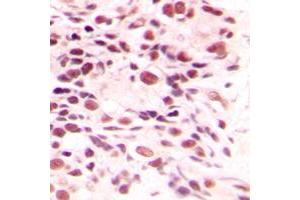 Immunohistochemical analysis of LYAR staining in human breast cancer formalin fixed paraffin embedded tissue section. (LYAR antibody  (Center))