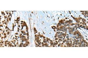 Immunohistochemistry of paraffin-embedded Human thyroid cancer tissue using CCDC12 Polyclonal Antibody at dilution of 1:60(x200) (CCDC12 antibody)