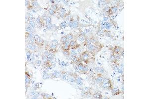 Immunohistochemistry of paraffin-embedded human liver cancer using TFR2 antibody (ABIN6128863, ABIN6149063, ABIN6149064 and ABIN6225172) at dilution of 1:100 (40x lens).