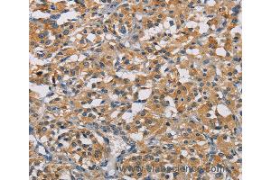 Immunohistochemistry of Human thyroid cancer using GPM6A Polyclonal Antibody at dilution of 1:50 (GPM6A antibody)