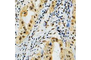 Immunohistochemical analysis of PRPF39 staining in human lung cancer formalin fixed paraffin embedded tissue section.