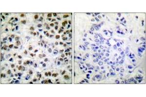 Immunohistochemistry analysis of paraffin-embedded human breast carcinoma, using POLR2A (Phospho-Ser1619) Antibody. (POLR2A/RPB1 antibody  (pSer1619))