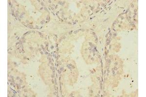 Immunohistochemistry of paraffin-embedded human prostate cancer using ABIN7173811 at dilution of 1:100 (TNFSF15 antibody  (AA 72-251))