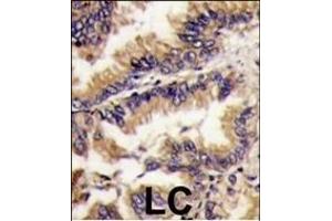 Forlin-fixed and paraffin-embedded hun lung carcino tissue reacted with PK1 Antibody (Center) (ABIN391367 and ABIN2841384) , which was peroxidase-conjugated to the secondary antibody, followed by DAB staining. (ERK2 antibody  (AA 154-183))