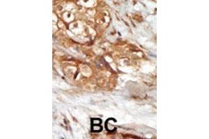 Formalin-fixed and paraffin-embedded human cancer tissue reacted with the primary antibody, which was peroxidase-conjugated to the secondary antibody, followed by AEC staining. (MAP3K14 antibody  (AA 119-148))