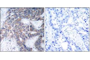 Immunohistochemical analysis of paraffin-embedded human breast carcinoma tissue, using MEK1 (phospho-Ser217) antibody (E011205). (MEK1 antibody  (pSer217))