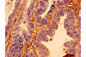Immunohistochemistry of paraffin-embedded human colon cancer using ABIN7172487 at dilution of 1:100 (BTF3 antibody  (AA 48-206))