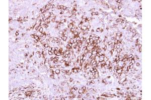 IHC-P Image Immunohistochemical analysis of paraffin-embedded human breast cancer, using CD40, antibody at 1:250 dilution. (CD40 antibody  (Center))