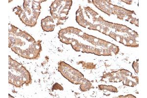 Formalin-fixed, paraffin-embedded human Small Intestinal Carcinoma stained with Villin-Monospecific Recombinant Mouse Monoclonal Antibody (rVIL1/1325). (Recombinant Villin 1 antibody  (AA 179-311))