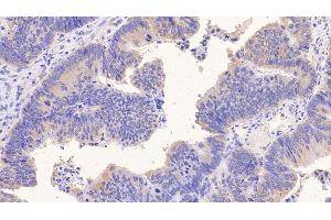 Detection of PIIINP in Human Colorectal cancer Tissue using Monoclonal Antibody to Procollagen III N-Terminal Propeptide (PIIINP) (PIIINP antibody)