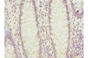 Immunohistochemistry of paraffin-embedded human colon cancer using ABIN7164852 at dilution of 1:100 (PTGES2 antibody  (AA 88-377))