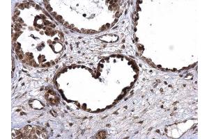IHC-P Image UBE3A antibody detects UBE3A protein at nucleus on human ovarian carcinoma by immunohistochemical analysis. (ube3a antibody)