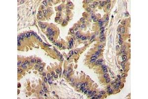 IHC analysis of FFPE human lung carcinoma tissue stained with BMP6 antibody (BMP6 antibody  (AA 25-55))
