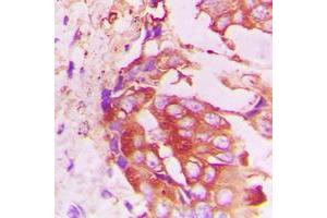 Immunohistochemical analysis of RhoH staining in human lung cancer formalin fixed paraffin embedded tissue section. (RHOH antibody  (C-Term))