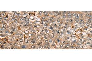 Immunohistochemistry of paraffin-embedded Human liver cancer tissue using CDT1 Polyclonal Antibody at dilution of 1:45(x200) (CDT1 antibody)