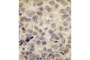 Formalin-fixed and paraffin-embedded human prostata carcinoma tissue reacted with Dnmt3b antibody (ABIN387884 and ABIN2844100) , which was peroxidase-conjugated to the secondary antibody, followed by DAB staining. (DNMT3B antibody  (AA 389-417))