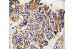IHC analysis of FFPE human lung carcinoma tissue stained with GRB2 antibody (GRB2 antibody  (AA 187-216))