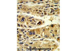 Formalin-fixed and paraffin-embedded human hepatocarcinoma reacted with ADH6 Antibody (Center), which was peroxidase-conjugated to the secondary antibody, followed by DAB staining. (ADH6 antibody  (Middle Region))