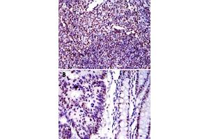 Immunohistochemical analysis of paraffin-embedded human tonsil tissue (A) and human colon cancer tissue (B) using XRCC5 monoclonal antobody, clone 5C5  with DAB staining. (XRCC5 antibody)