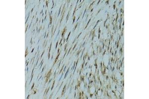 Immunohistochemistry of paraffin-embedded human uterine cancer using GABPA antibody (ABIN6127940, ABIN6140889, ABIN6140892 and ABIN6224475) at dilution of 1:100 (40x lens). (GABPA antibody  (AA 1-260))