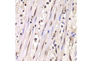 Immunohistochemistry of paraffin-embedded human mammary cancer using LSM4 antibody (ABIN5973492) at dilution of 1/100 (40x lens). (LSM4 antibody)