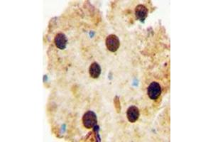 Immunohistochemistry analysis in formalin fixed and paraffin embedded human skin carcinoma reacted with OAZ2 Antibody (C-term) followed by peroxidase conjugation of the secondary antibody and DAB staining. (OAZ2 antibody  (C-Term))