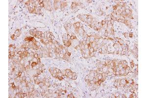 IHC-P Image SMAD9 antibody detects SMAD9 protein at cytoplasm on human breast carcinoma by immunohistochemical analysis.
