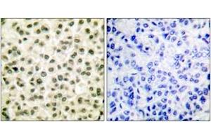 Immunohistochemistry analysis of paraffin-embedded human breast carcinoma tissue, using Ku70/80 Antibody. (Ku70/80 (AA 683-732) antibody)