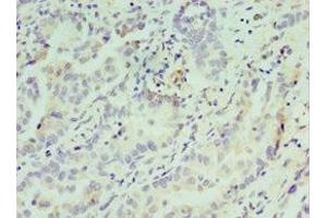 Immunohistochemistry of paraffin-embedded human lung cancer using ABIN7148809 at dilution of 1:100 (ATF7 antibody  (AA 1-117))
