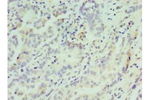 Immunohistochemistry of paraffin-embedded human lung cancer using ABIN7148809 at dilution of 1:100 (AFT7 antibody  (AA 1-117))