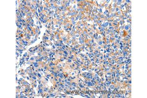 Immunohistochemistry of Human ovarian cancer using HCN2 Polyclonal Antibody at dilution of 1:80 (HCN2 antibody)