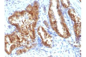 Formalin-fixed, paraffin-embedded human Prostate Carcinoma stained with AMACR / p504S Rabbit Polyclonal Antibody.