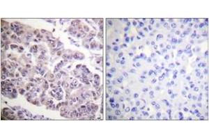 Immunohistochemistry analysis of paraffin-embedded human breast carcinoma tissue, using Histone H4 (Acetyl-Lys12) Antibody.
