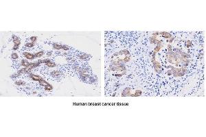 Paraffin embedded sections of human breast canitrocelluloseer tissue were initrocelluloseubated with anti-human PPIF (1:50) for 2 hours at room temperature. (PPIF antibody  (AA 30-207))