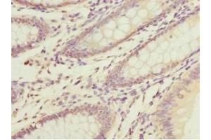 Immunohistochemistry of paraffin-embedded human colon cancer using ABIN7150497 at dilution of 1:100 (DNAJA2 antibody  (AA 233-412))