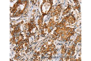 Immunohistochemistry of Human liver cancer using SLC5A11 Polyclonal Antibody at dilution of 1:35 (Solute Carrier Family 5 (Sodium/inositol Cotransporter), Member 11 (SLC5A11) antibody)