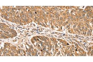 Immunohistochemistry of paraffin-embedded Human lung cancer using RPLP2 Polyclonal Antibody at dilution of 1:35 (RPLP2 antibody)